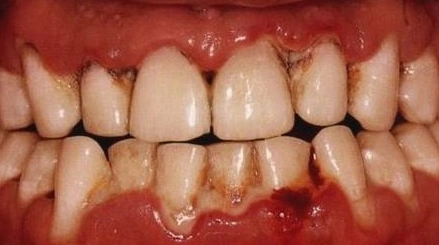 重度牙周炎