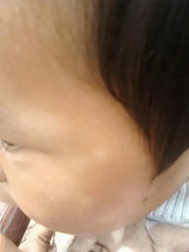 儿童脸上有白斑是怎么回事