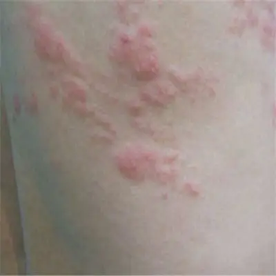 性病的早期症状图片 (7)_有来医生