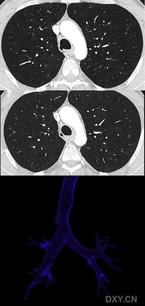 【影像读片】气管憩室ct三维重建 [病例帖]