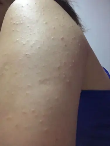 手臂外侧长了很多脂肪粒,可以挤出白色的东西,以前瘦的时候没有这么多