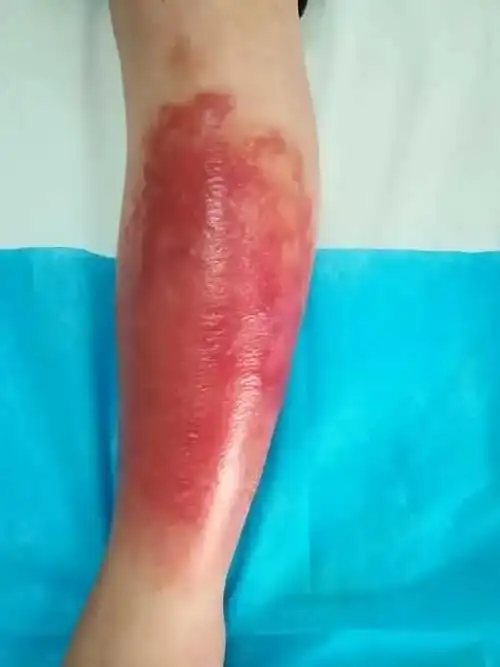 小腿又红又肿又痛咋回事