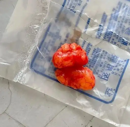 独自去做了个小手术脂肪瘤