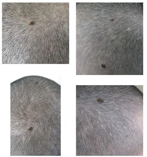 我的头皮上长了七八个很大的痣.不知道什么时候开始的,专业人士求助.