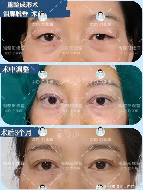 双眼皮77泪腺脱垂复位  术后3个月分享