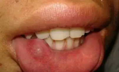 楼主踏青放牛2014-06-07 04:04:12粘液腺囊肿是口腔常见病,其表现为