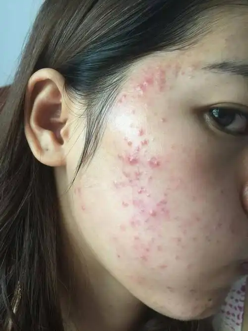 春季脸上长痘两周不好,多半是螨虫痘,3招教你如何祛痘除螨!_痘痘