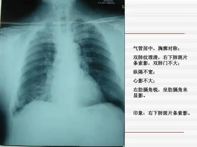 右下肺斑片 条索影,双肺门不大; 纵隔不宽; 心影不大; 右肋膈角锐,坐