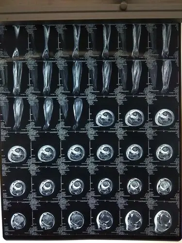 患儿急性血源性骨髓炎