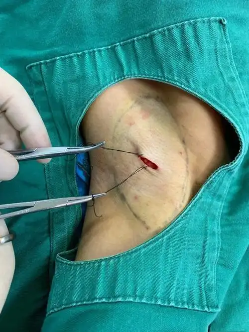 微创腋臭根治术,解决狐臭烦恼?_腋臭_治疗方法_治疗方式 - 好大夫在线