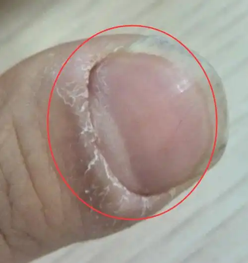 指甲周边的肉变厚,裂开是怎么回事