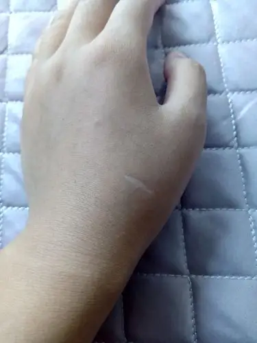 这个手上疤痕严重吗?有影响美观吗?