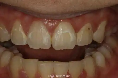 渗透树脂治疗正畸后白垩斑一例