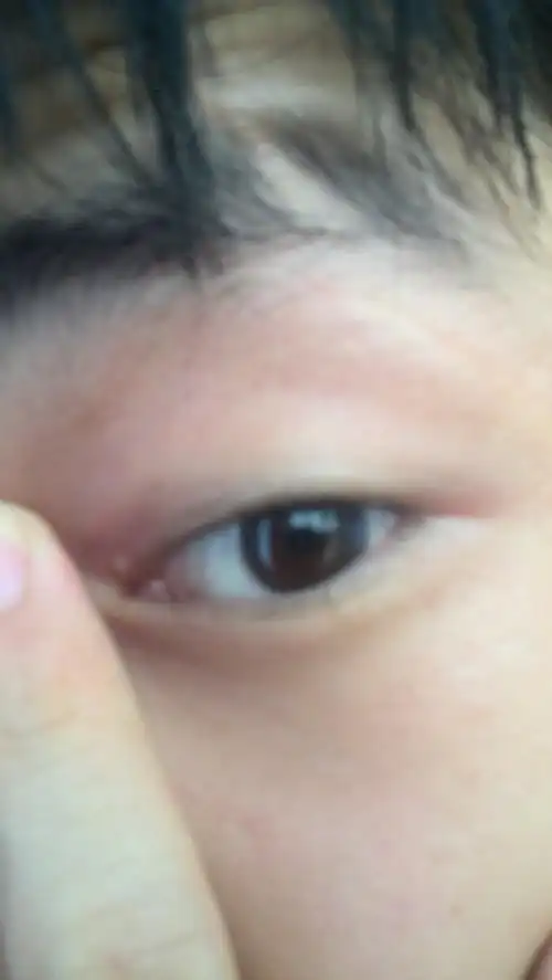 眼角有一粒肉色的