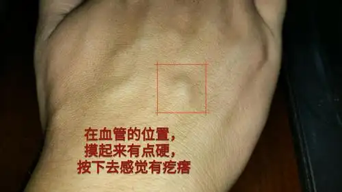 手背血管位置长了一个鼓包,小疙瘩,按下去有点硬,使劲的话感觉里面