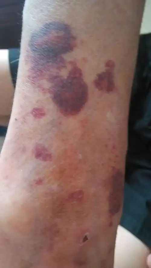 问:我爷爷今年67岁,有皮肤病,还有高血压,下手臂上长了一块红带紫的