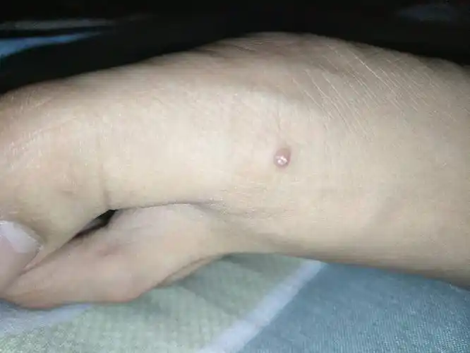 脚背上长得小疙瘩是什么,把它剪掉了又长了还是原来得位置.
