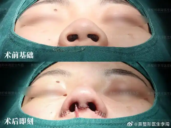 提升术前基础:鼻背宽平,面中部凹陷,鼻尖和下小叶凸度不足,双侧鼻翼