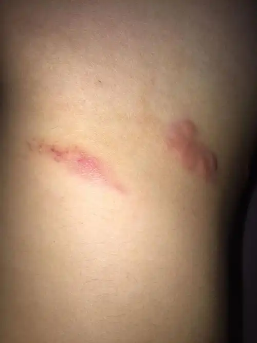 腰部附近起很多红疙瘩,很痒