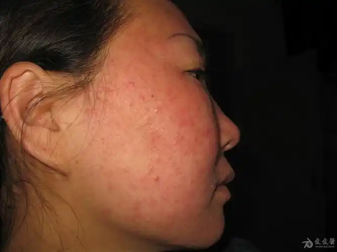 所见最严重的面部蠕型螨皮炎1例