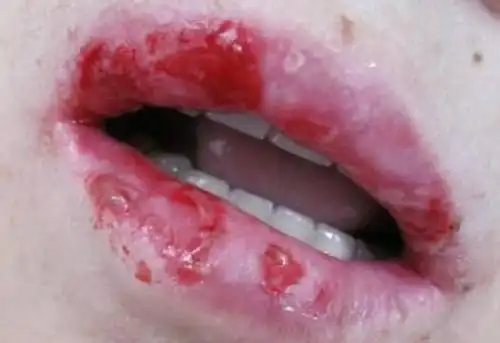 日常如何预防唇炎的"纠缠"?