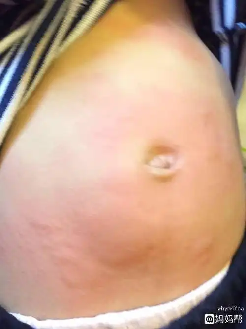 孤零零!小孩荨麻疹怎么治疗"不即不离"-第1张图片-飘零博客