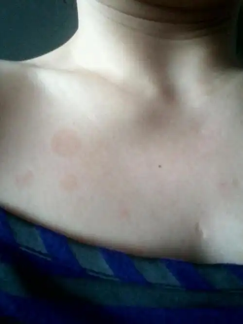 为什么身上会长这几个圆圈,太丑了?