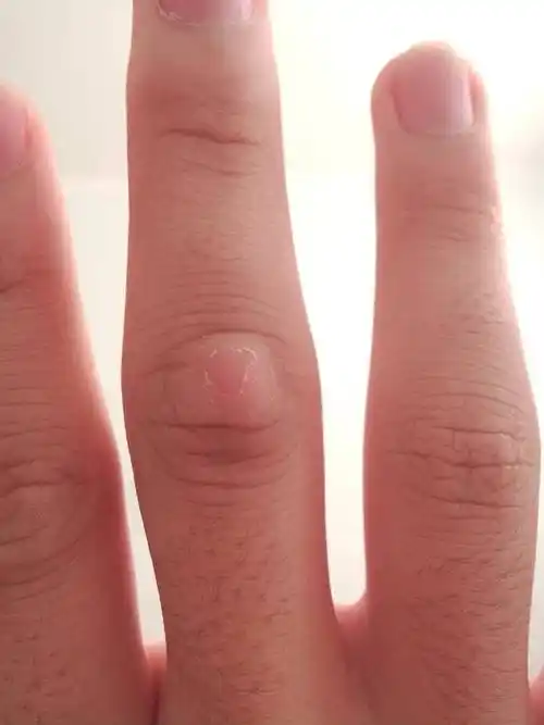 手指骨节这样.像是多了个包一样,怎么回事,应该怎么办?