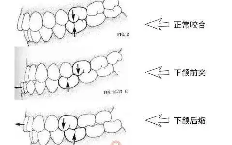 杭州口腔咬合关系紊乱科普