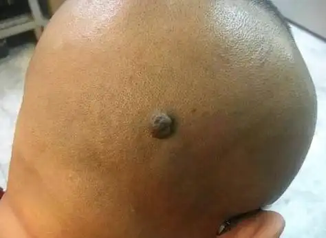 头顶发中藏有瘊子,则开运能量强,属于闭月羞花痣.