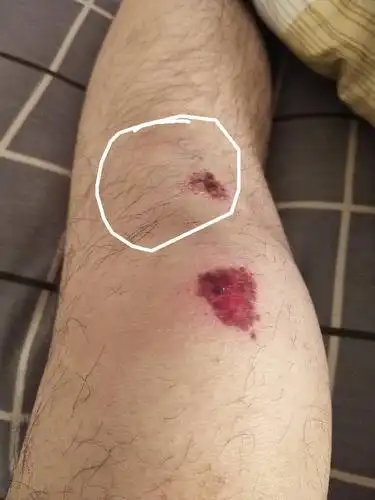 30左右骑车摔的,腿不能后抬.