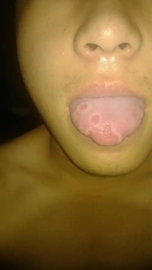 舌头上出现白圈是怎么回事啊,早上刷牙发现的,急急急!