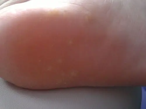 脚底长了很多黄豆大小的透明色硬泡,是鸡眼吗?不是的话,又是什么东西?