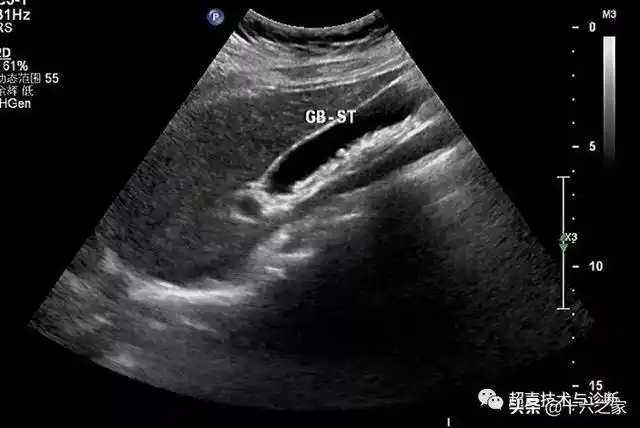 腹部超声 | 不典型胆囊结石——泥沙样结石