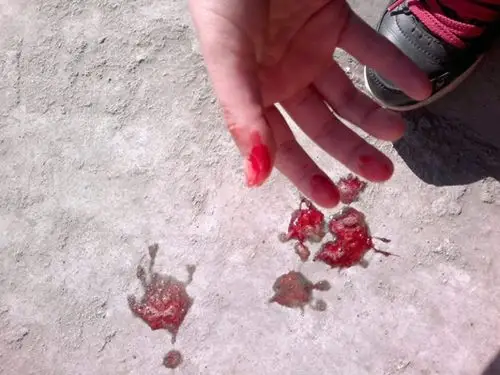 吐血图片 (25)_有来医生