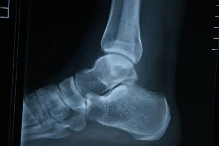 你好,三周前,我从高处跳下,伤到了脚踝,请您帮我看看x光片,看是哪里