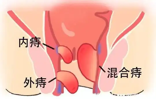 人体痔疮长什么样子的图片在哪个位置内痔在齿状线以上会出血