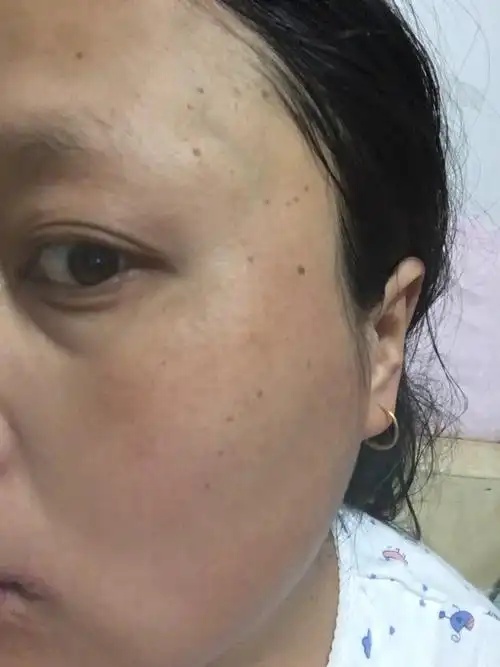 怀孕后斑越来越多了!