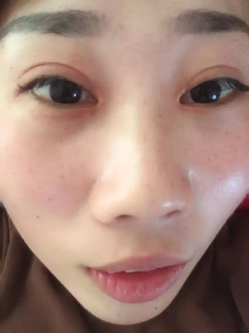 想问下小姐姐们 开双眼皮两个月了 内眼角处的增生还是有怎么办 每天