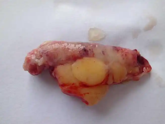 阑尾炎手术后投保 阑尾炎手术后可以买健康险吗