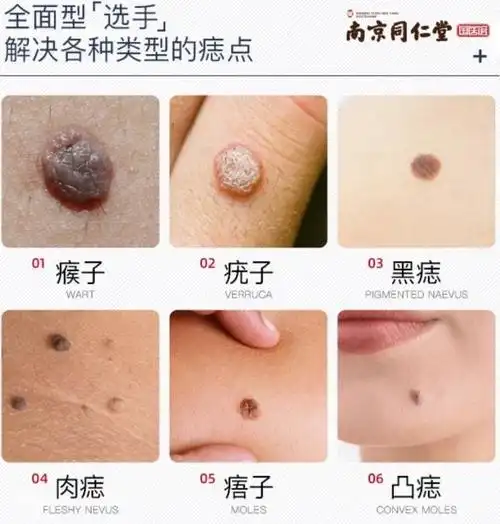 黑痣瘊子痦子让你丑爆了用它无痛无刺激不留疤7天黑痣自然剥落
