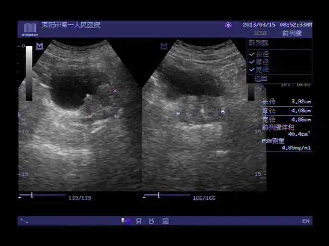 超声入门贴41膀胱癌