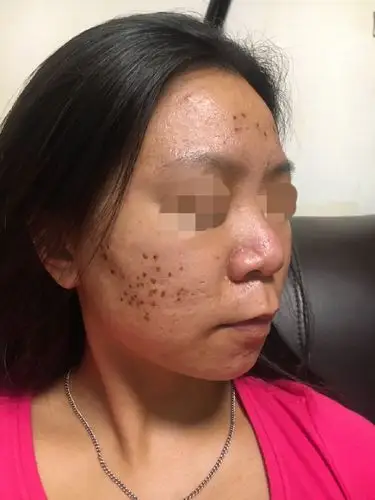 点阵激光第八天