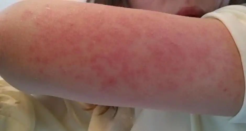 紫外线过敏怎么办 它有哪些症状表现