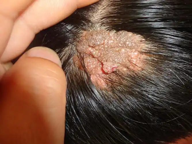 病例分享皮脂腺痣