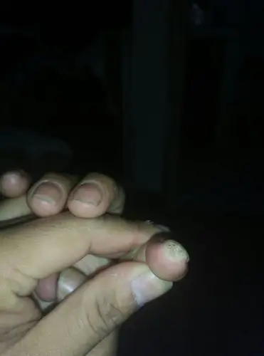 手指甲这里长了个东西,皮肤病吗?很硬很痛,看下到底什么情况.