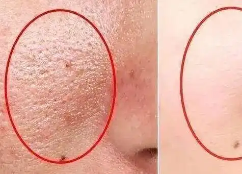 粉刺和螨虫的区别图片(螨虫粉刺是什么样子的) 第3张