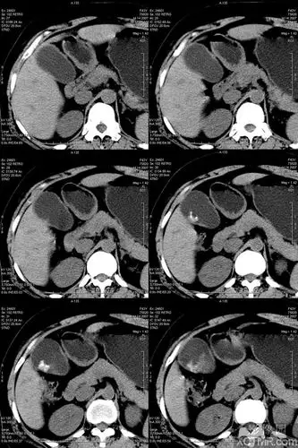 慢性胆囊炎并胆囊结石ct病例图片影像诊断分析
