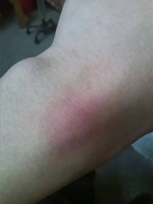 从去年夏天一次用洗衣粉洗过衣服后,手上开始出现红