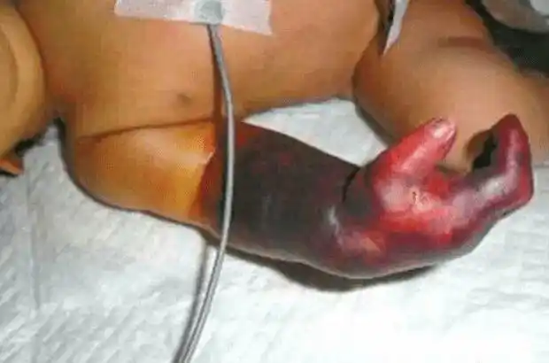 宝宝手指小伤变截肢奶奶悔断肠这些习惯太可恨